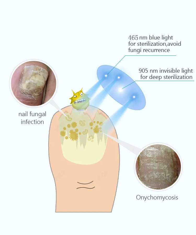 HZJ-02 Nail Fungus Cold Laser Therapy Device (4)