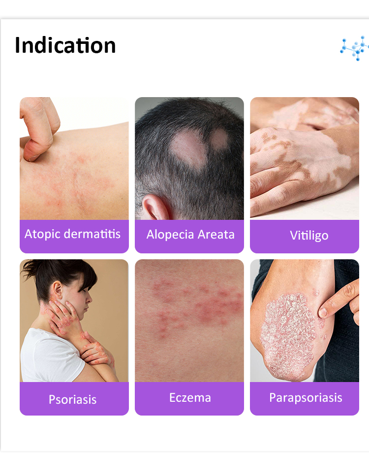 UVB light therapy indications