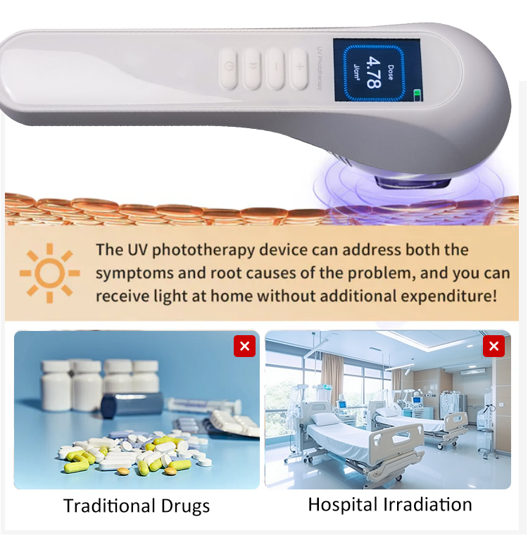 How 308nm UVB light therapy works